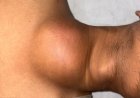 KIMS Doctors Save 21yr Old with Leaking Artery from Heart 