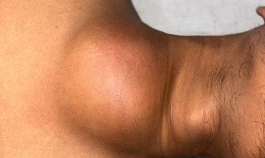 KIMS Doctors Save 21yr Old with Leaking Artery from Heart 