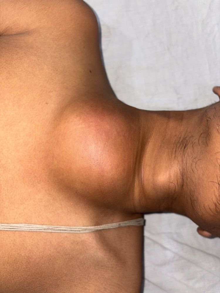 KIMS Doctors Save 21yr Old with Leaking Artery from Heart 